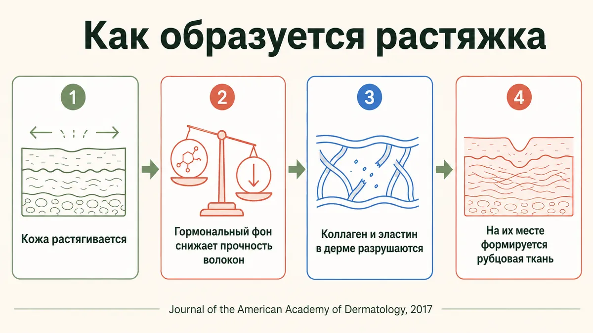 Как образуется растяжка: растяжение кожи, распад эластина, рубцовая ткань